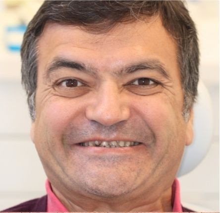 Before — CDCP smile restoration